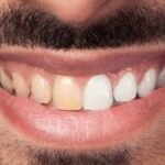 Everyday Habits That Can Stain Your Teeth