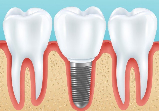 Implants Look Artificial and Unnatural