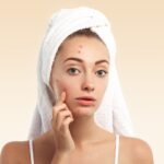 What Really Causes Acne?